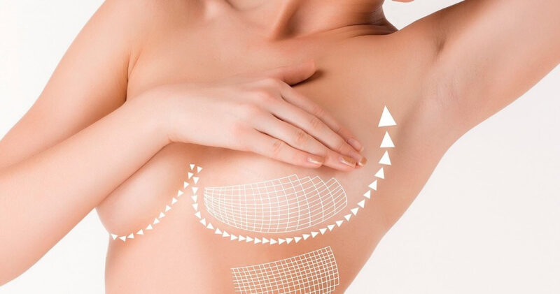 Маммопластика — операция по увеличению груди